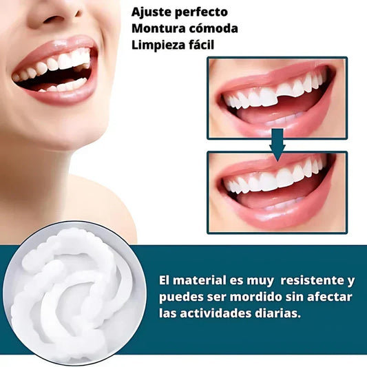 SmilePro — Carillas dentales ajustables de resina