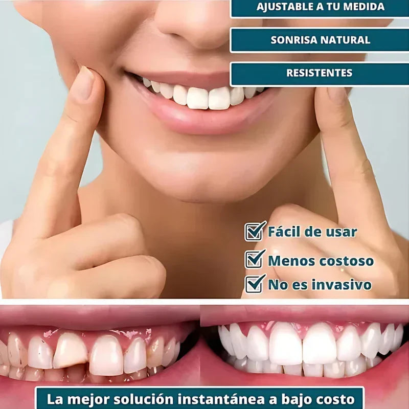 SmilePro — Carillas dentales ajustables de resina